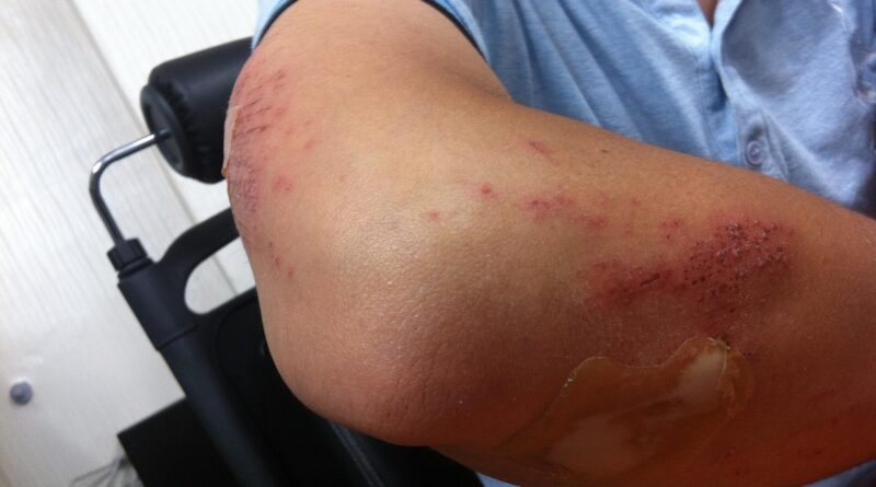 injury, arm, injured, hurt, man, elbow, pain, bandage, treatment, medical, health, accident, patient, scrape, scrapes, bruise, bruises, bruising, painful, ache, human, body, emergency, injury, injury, injury, injury, injury, injured, injured, elbow, elbow, elbow, bandage, bruise, bruise, bruise, bruise, bruises