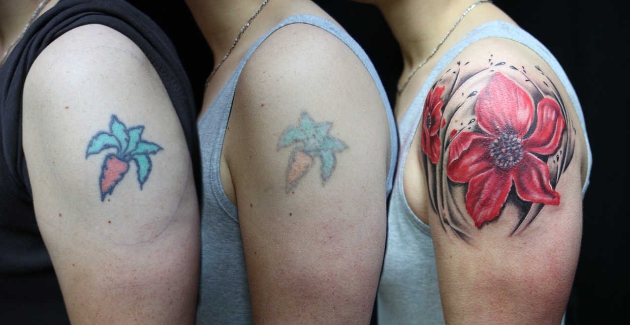 tattoo, remove laser, laser, tattoo, tattoo, tattoo, tattoo, tattoo, remove laser, laser